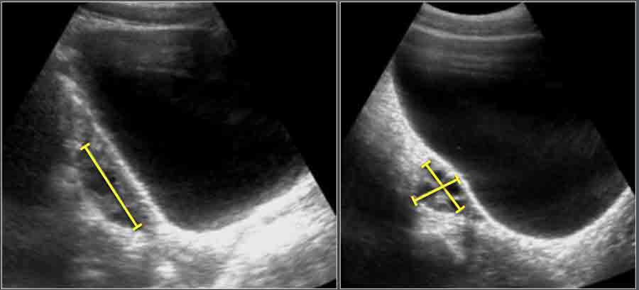 The Radiology Assistant Normal Values Ultrasound The Radiology Assistant Normal Values Ultrasound