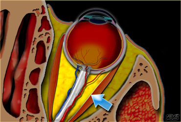 The intraconal space is marked by arrows and is located within the muscle cone It contains the optic nerve, vessels and cranial nerves III, IV and VI.