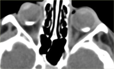 Retinoblastoma: axial FLAIR (left) and coronal enhanced T1WI (right)