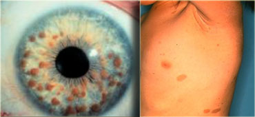 LEFT: multiple iris hamartomas (Lisch nodules) RIGHT: axillary freckling (small brown spots)  and caf? au lait spots