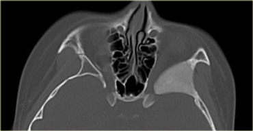 Fibrous dysplasia of the sphenoid wing