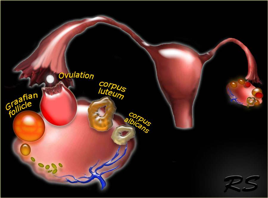 The Radiology Assistant Ovarian Cysts Common Lesions