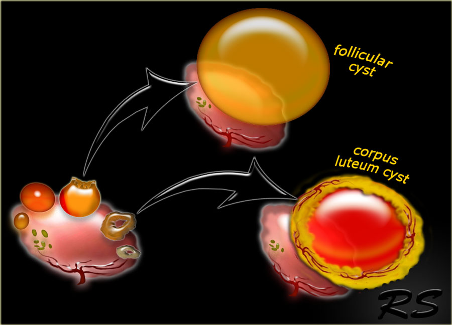 how-big-is-2-cm-cyst-on-ovary-ovarian-cysts-in-the-neonate-are