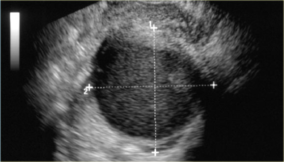 Vaginal ultrasound showing a large hypoechoic cystic lesion with diffuse low-level echo's