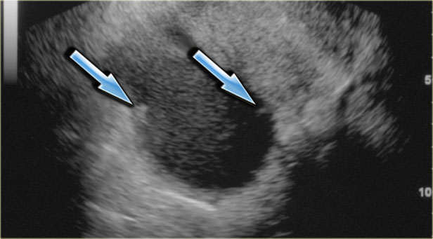 Transvaginal ultrasound: endometrioma with two hyperechoic wall foci, consistent with cholesterol deposits (arrows)