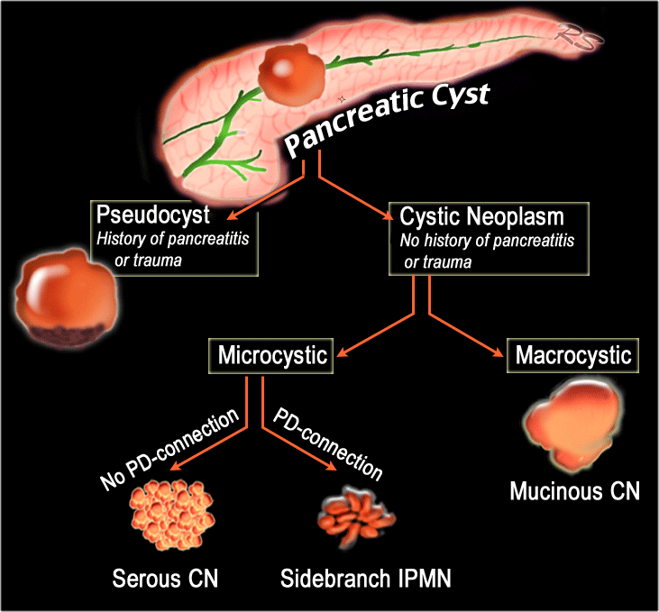 The Radiology Assistant Pancreatic Cystic Lesions