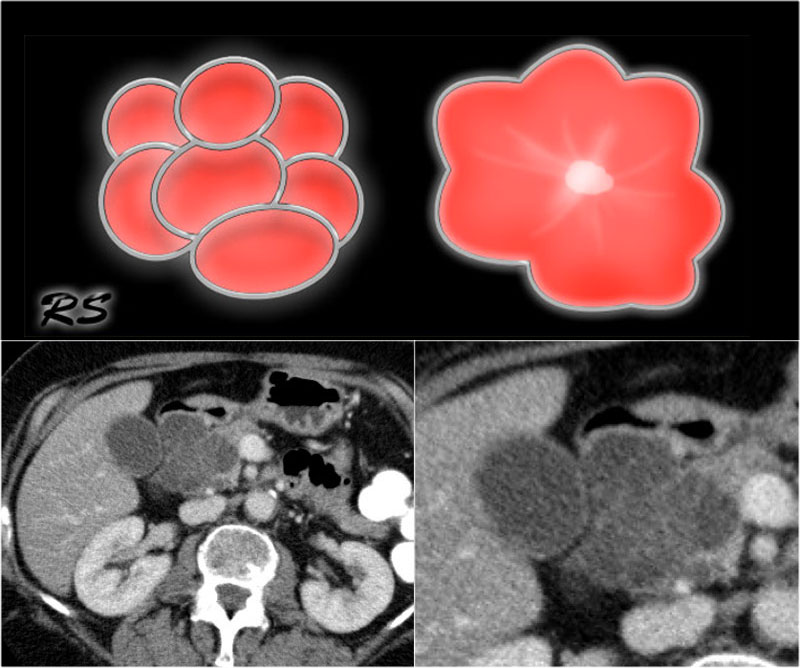 The Radiology Assistant : Pancreas - Cystic Lesions