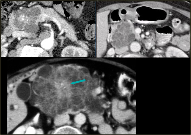 Serous Cystic Neoplasm. Courtesy Koenraad Mortel, Dept Radiology, Brigham and Women's hospital, Boston