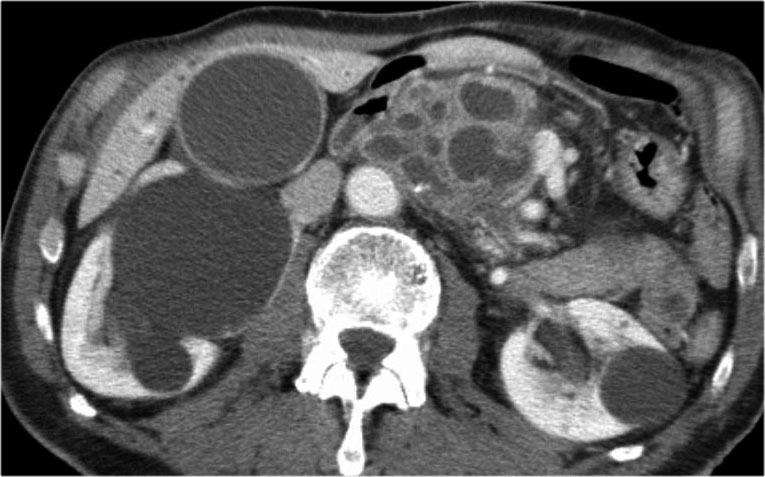 The Radiology Assistant : Pancreas - Cystic Lesions