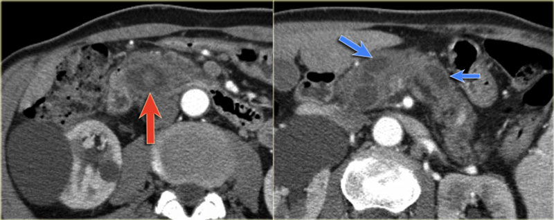 The Radiology Assistant Pancreatic Cystic Lesions