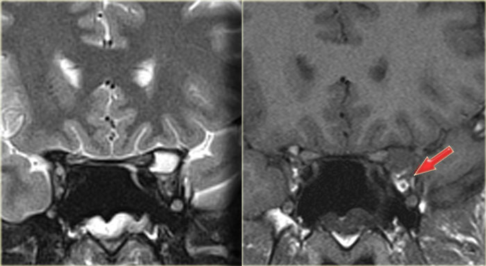 Mucocele of the anterior clinoid with secondary involvement of the optic nerve