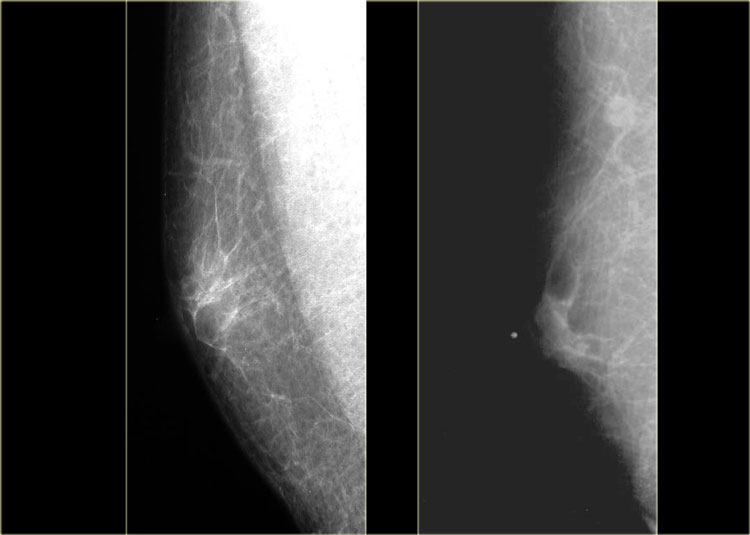 Mammogram atypical mass large breasts The Radiology Assistant Pathology Of The Male Breast
