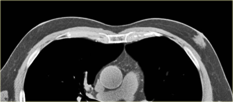 Gynecomastia nodular pattern: Incidental finding on CT-scan