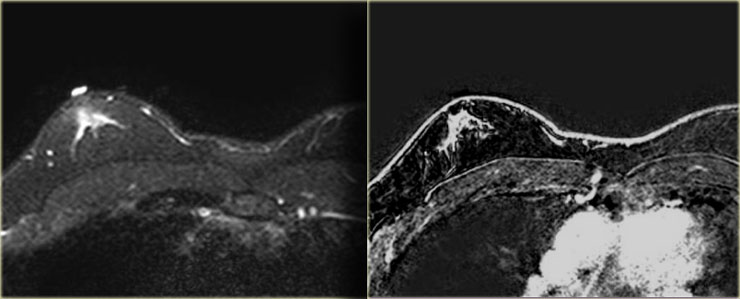 Gynecomastia nodular pattern: T2W-fatsat and T1WI+Gd