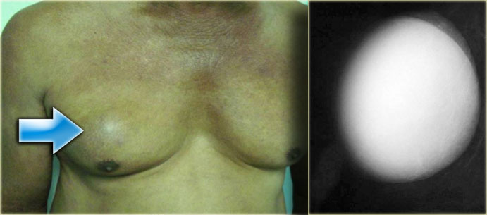 Breast mammogram showed bilateral benign gynecomastia, with the right