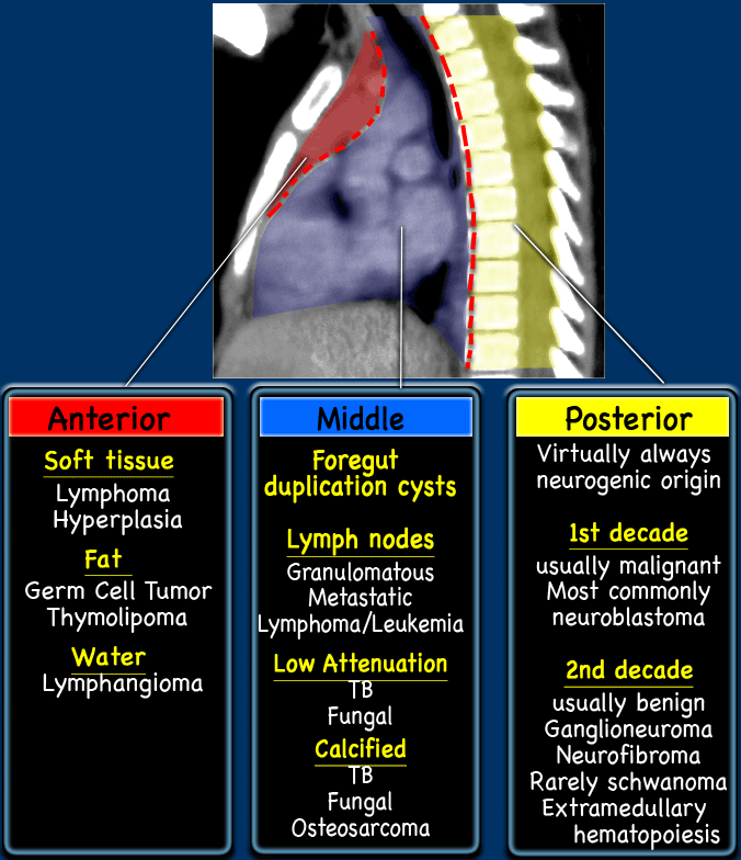 The Radiology Assistant : Nonvascular Mediastinal Masses