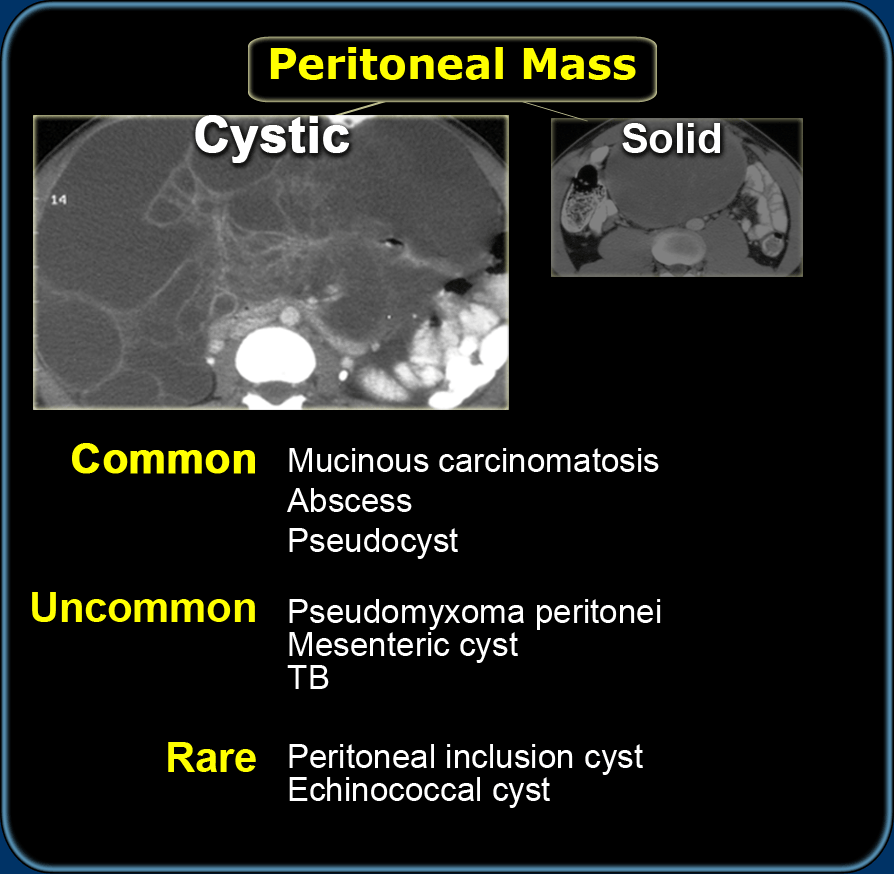 The Radiology Assistant : Endometriosis - MRI detection