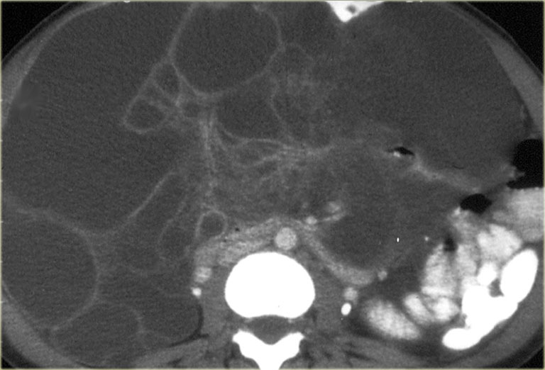 prognosis with malignant pleural effusion