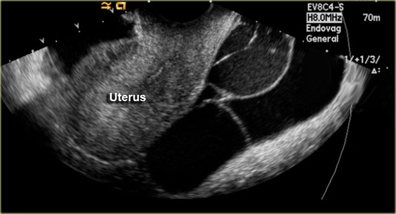 peritoneal cancer immunotherapy