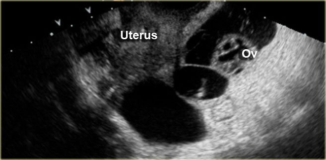Peritoneal Inclusion Cyst with trapped ovary within septated fluid collection