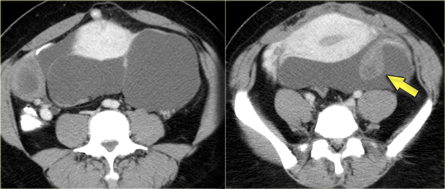 The Radiology Assistant Peritoneal Pathology