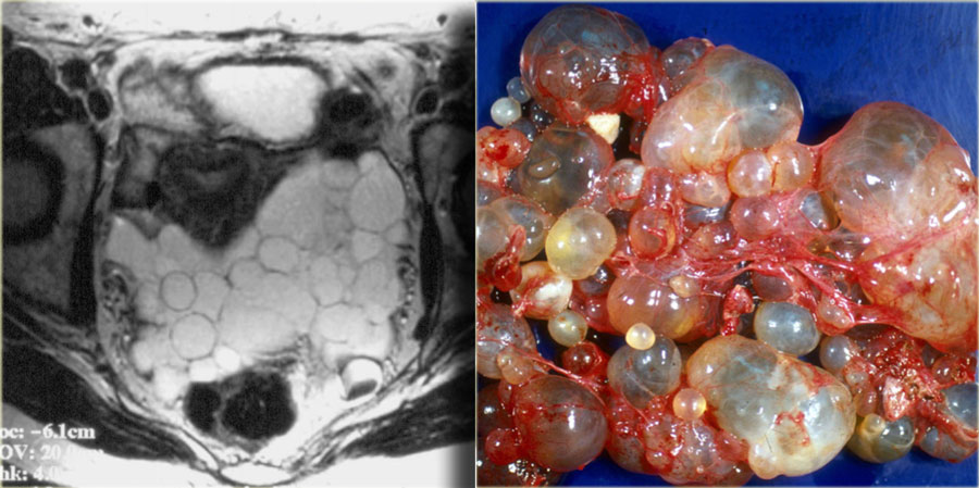 The Radiology Assistant Peritoneal Pathology