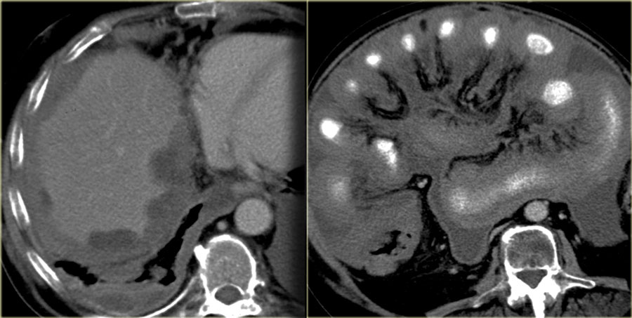 multicystic benign mesothelioma pathology outlines