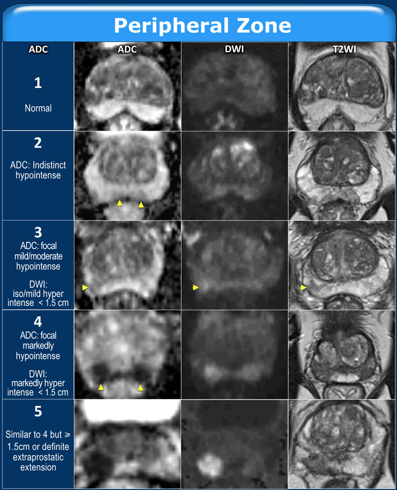 prostate volume normal range radiology