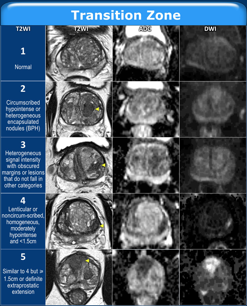 MULTIPARAMETRIC MR IMAGING OF PROSTATE TUMORS: PI-RADS V | SCIENTIFIC JOURNAL OF THE