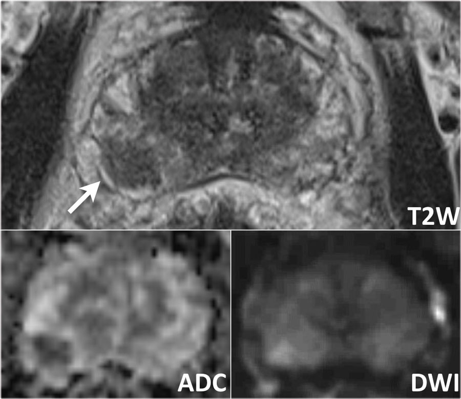 prostate adenoma radiopaedia)