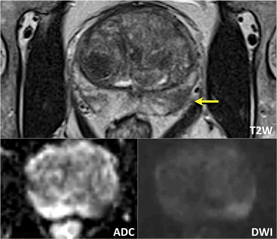 Prostate cancer staging mri radiographics. Case report