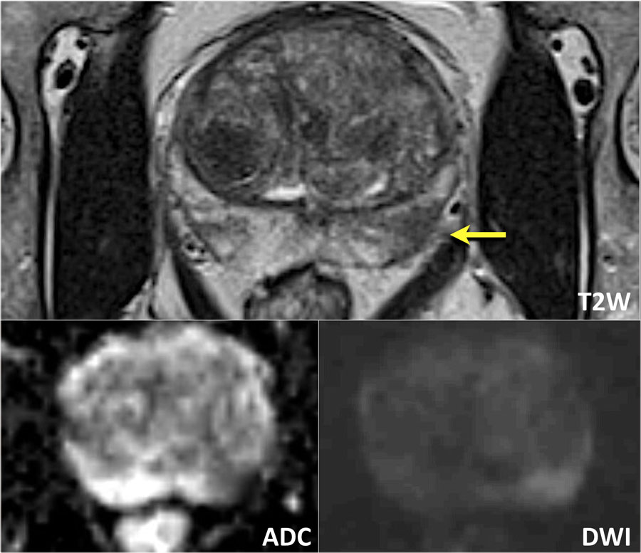 prostatitis mri findings)