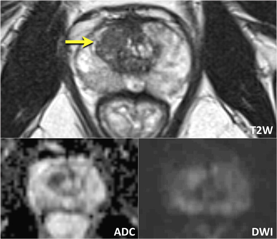 prostate zones mri)