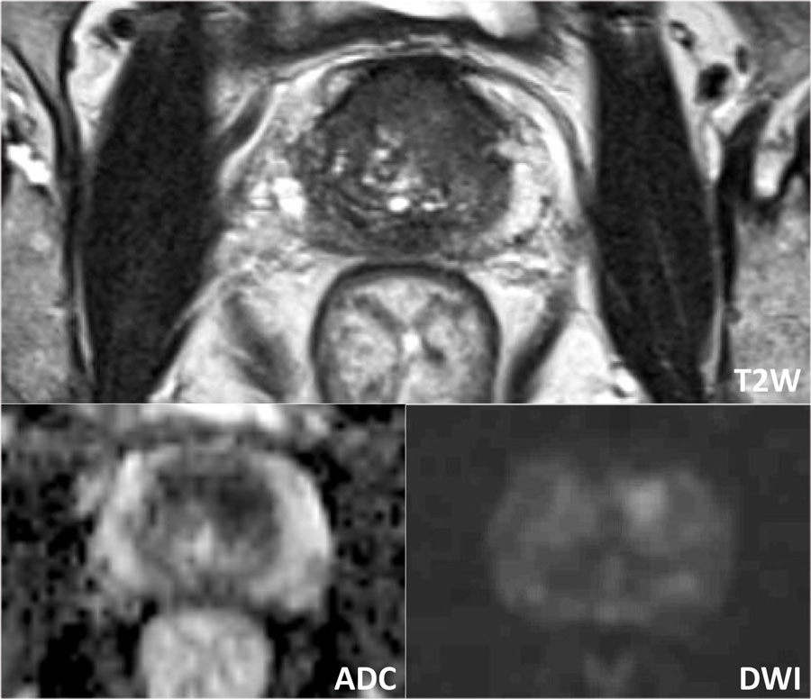 multiparametric prostate mri radiology assistant)