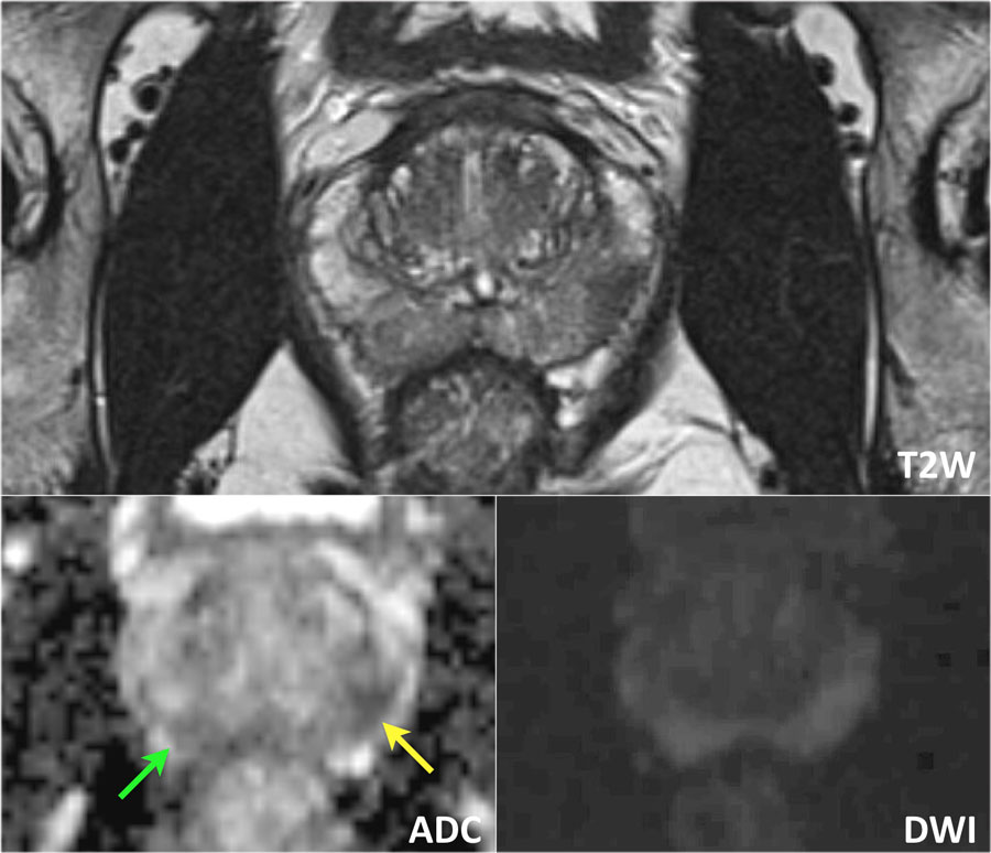 The Radiology Assistant : Prostate Cancer - PI-RADS V2