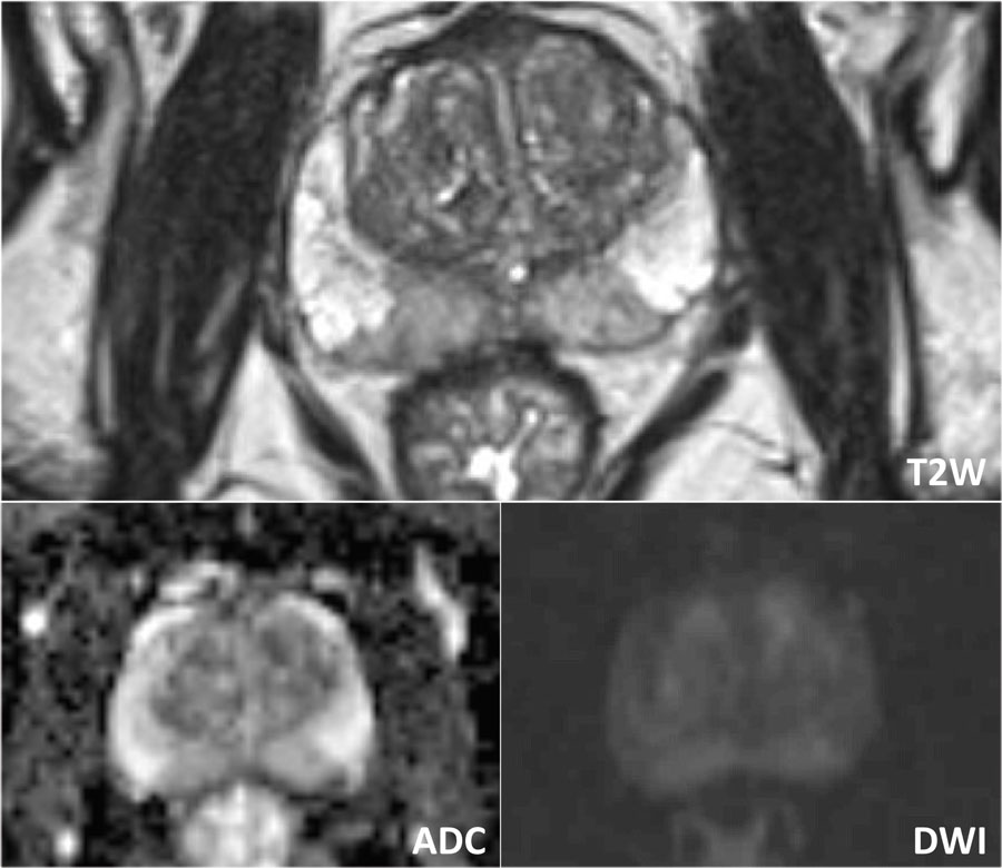 prostatitis mri findings)