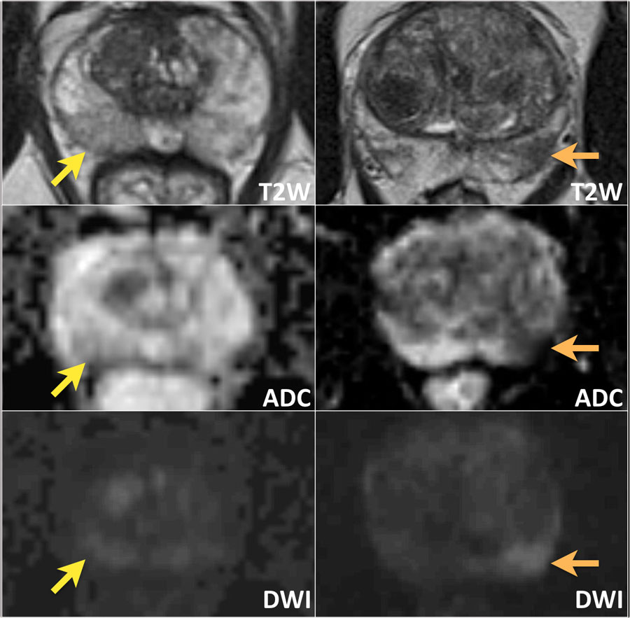 Prosztatarák: MRI