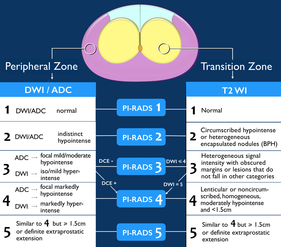 bph vs prostate cancer zone