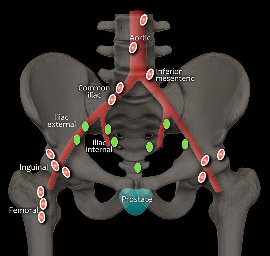 mri prostate cancer staging)