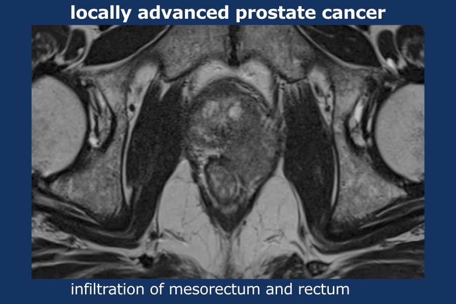 The Radiology Assistant Prostate Cancer Pi Rads V2