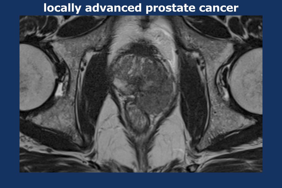 The Radiology Assistant Prostate Cancer Pi Rads V2 2490