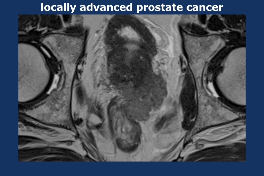 prostate cancer pi rads radiology assistant