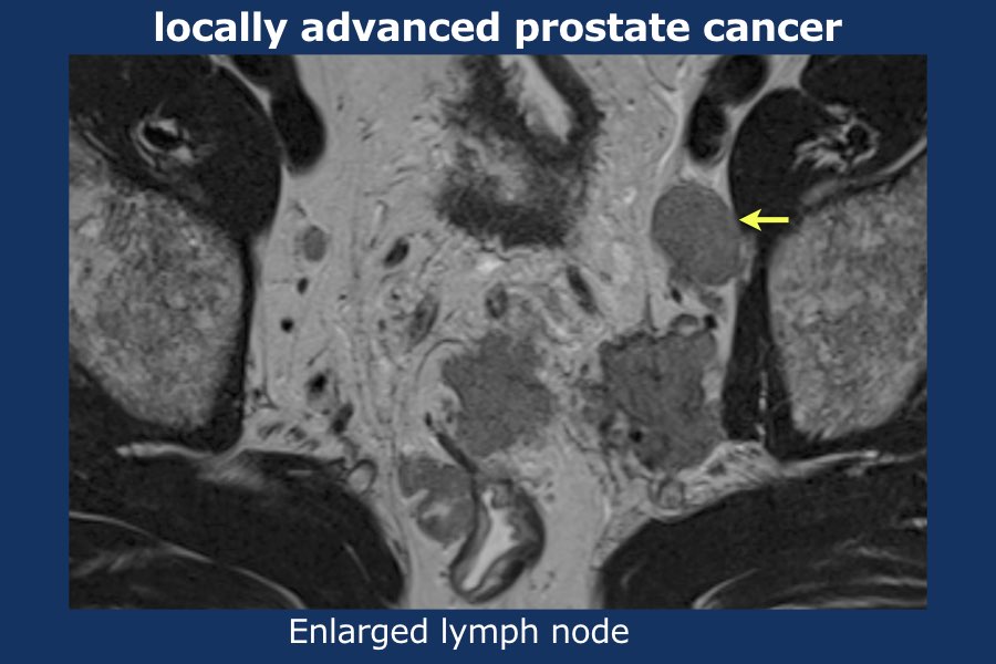 adenocarcinoma prostata classificazione gleason 8