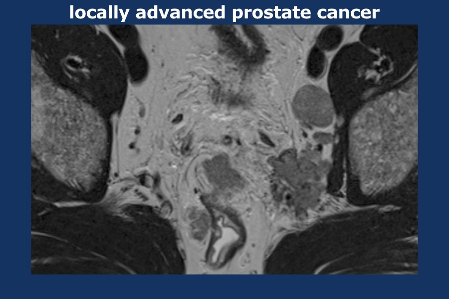 The Radiology Assistant Prostate Cancer Pi Rads V2 8964