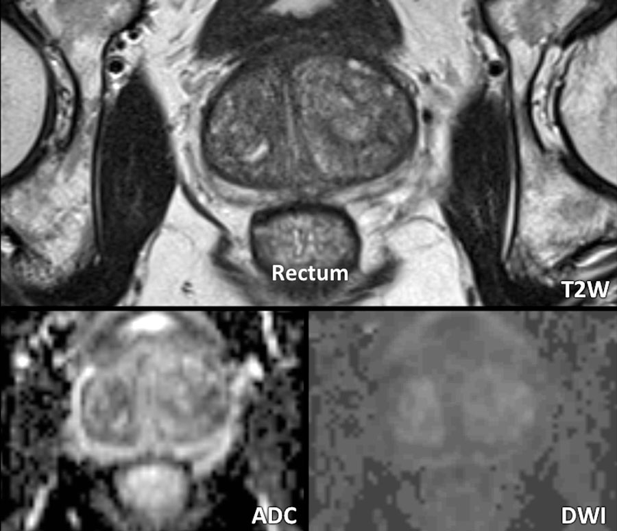 multiparametric mri prostate preparation)