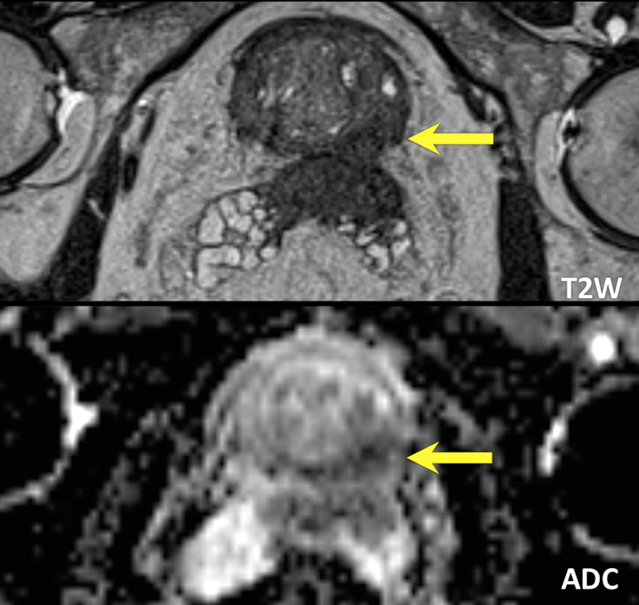 Status postneoplasm prostatic iradiat