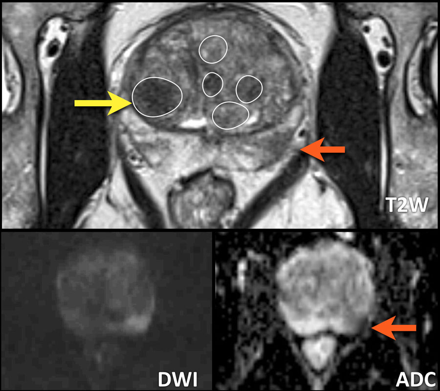 prostate normal size in cc radiology)