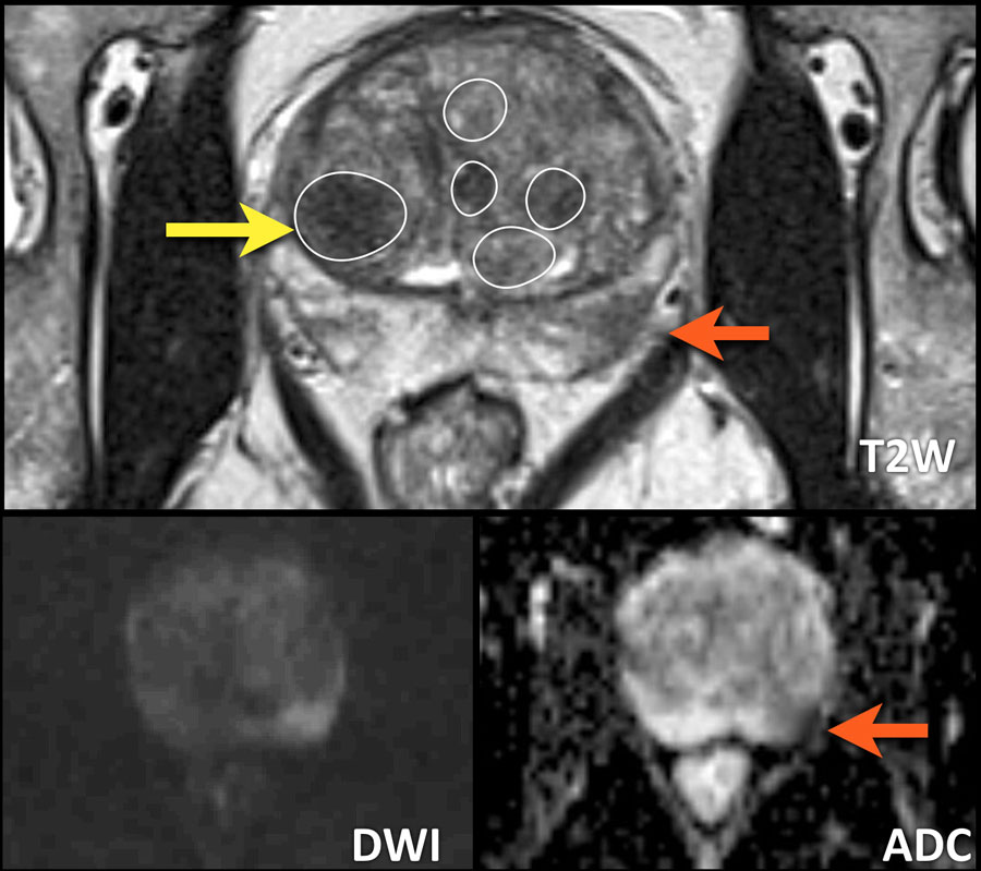 prostate volume normal range radiology)