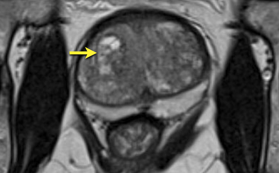 prostate adenoma radiology