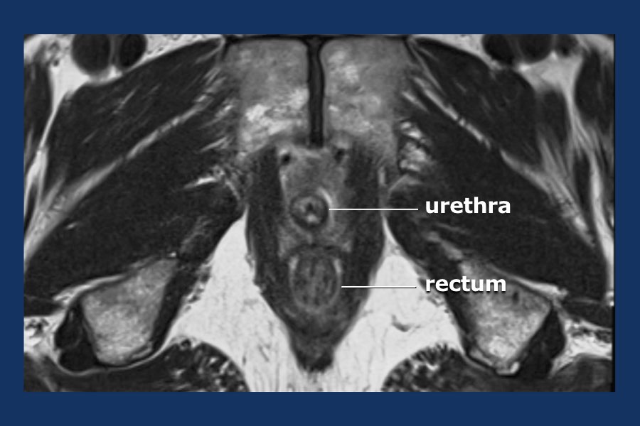 prostate anatomy mri images analiza psa pret regina maria